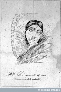 After masturbation. Mlle Chxx aged 16 years (1836). Credit: Wellcome Library, London.