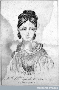 Before masturbation. Mlle Chxx aged 15 years (1836). Credit: Wellcome Library, London.