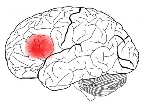 Broca's area, a region of the brain associated with occurrences of foreign accent syndrome.