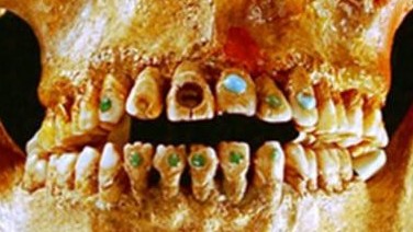 ancient-dentistry-golden-bridges