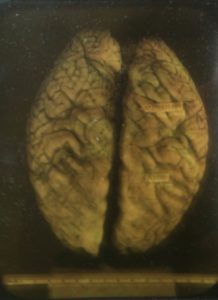 Nazi Robert Ley's brain, as photographed by the U.S. Army Institute of Pathology.